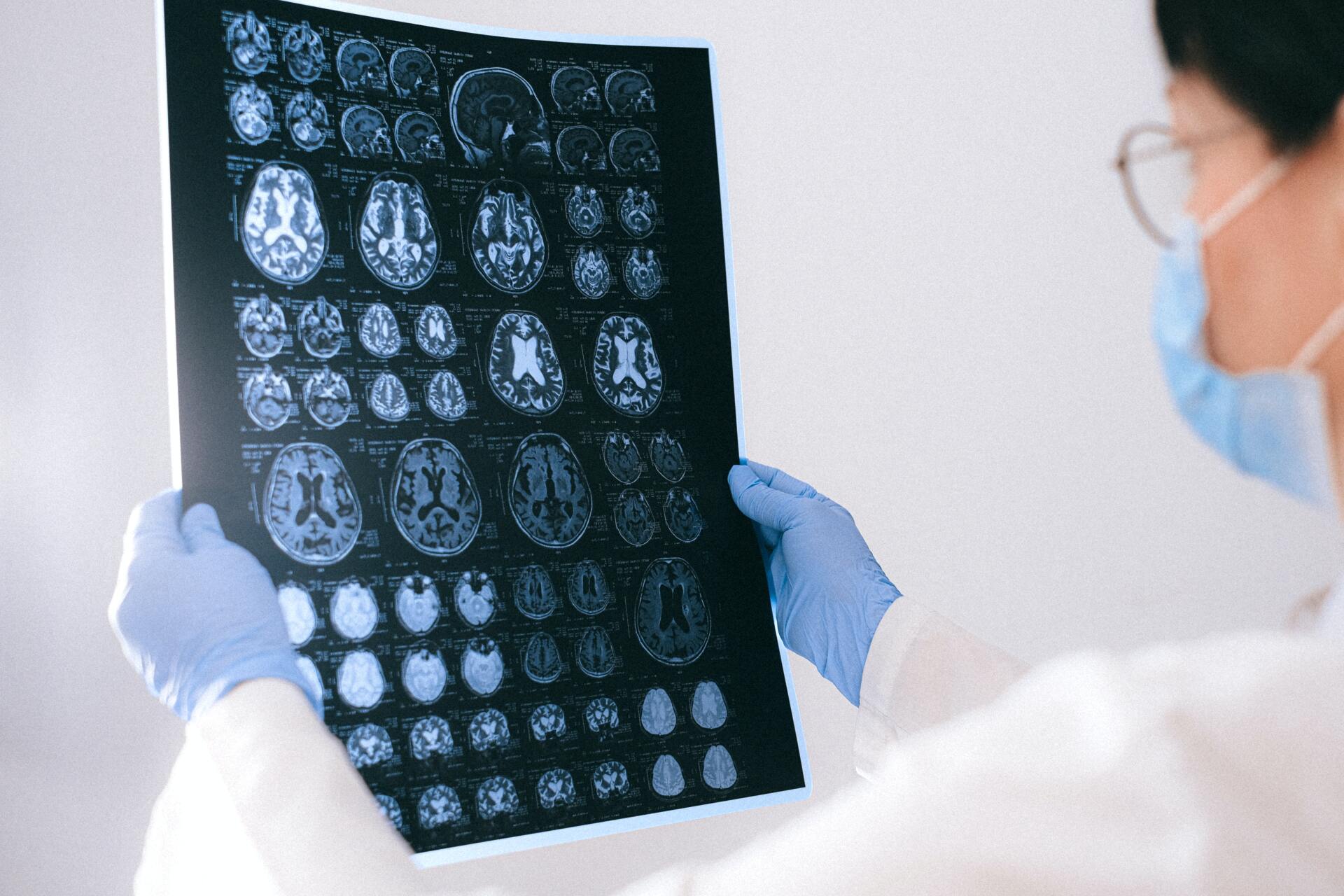 Epilepsia, saiba o que é! O que é epilepsia?
