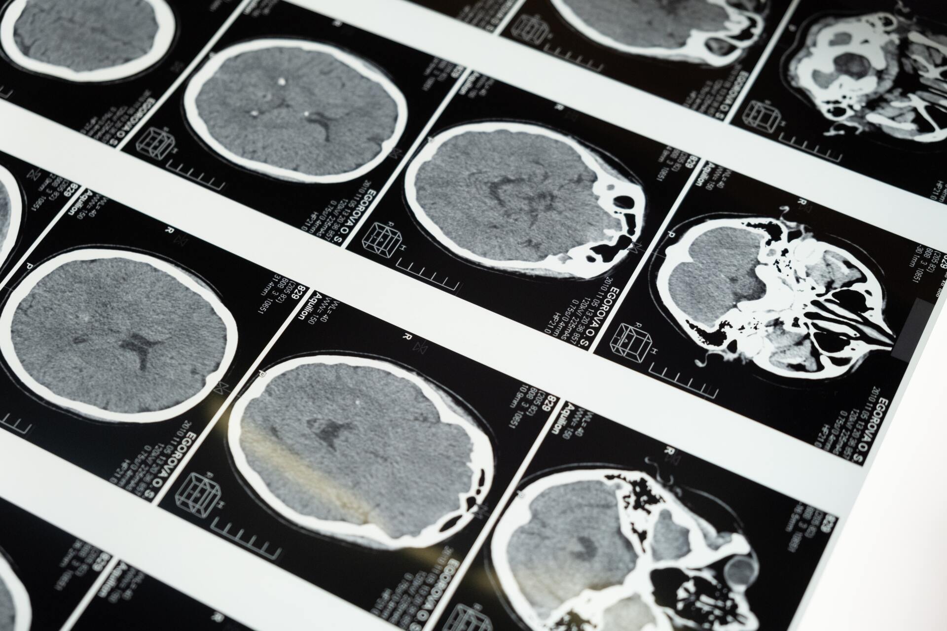 Cirurgia para epilepsia. Quando a cirurgia é indicada para pacientes com epilepsia?