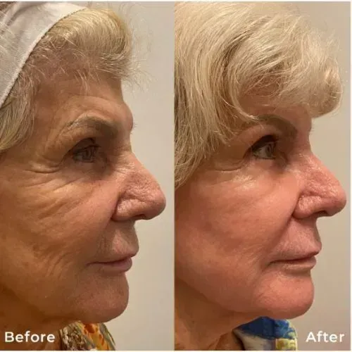 Before and after skin resurfacing for crow’s feet and fine lines, Skin & Tonic Pace FL