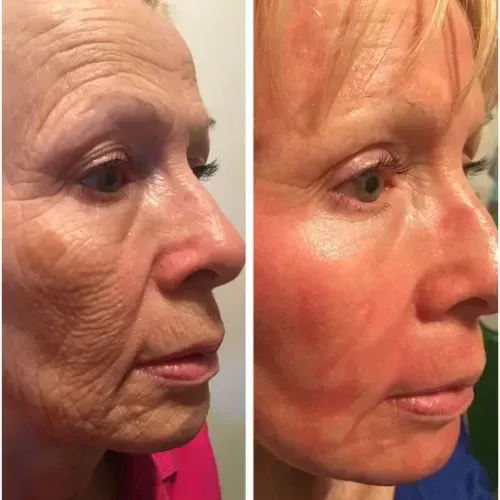 Before and after skin resurfacing for under-eye wrinkles, Skin & Tonic Pace FL