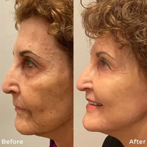 Before and after skin resurfacing for facial wrinkles and texture, Skin & Tonic Pace FL