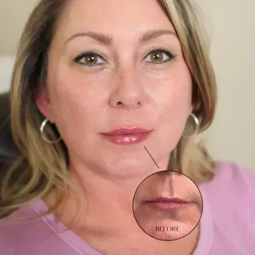 Before and after lip enhancement for natural-looking lip volume, Skin & Tonic Pace FL