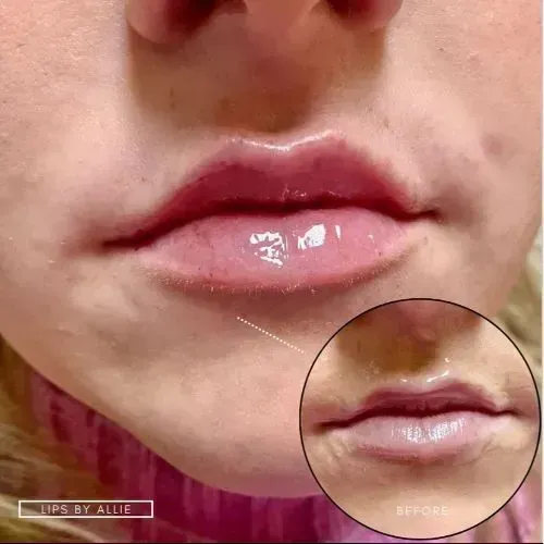 Before and after lip filler for improved lip shape and definition, Skin & Tonic Pace FL