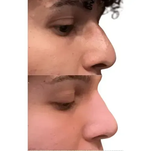 Before and after liquid rhinoplasty for refined side profile, Skin & Tonic Pace FL