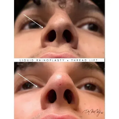 Before and after non-surgical nose contouring for improved nasal shape, Skin & Tonic Pace FL