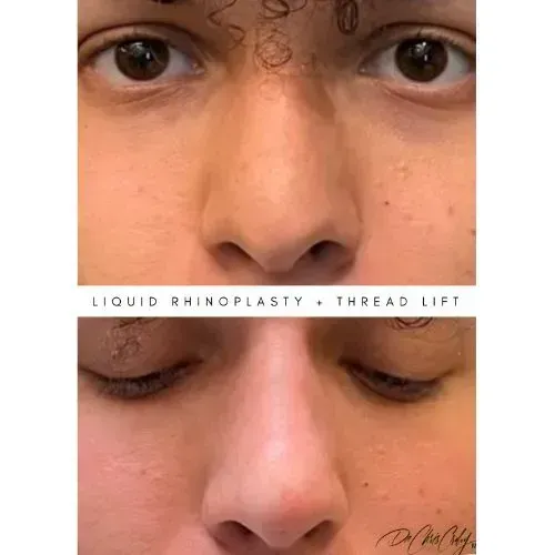 Before and after non-surgical nose treatment for smoother bridge definition, Skin & Tonic Pace FL