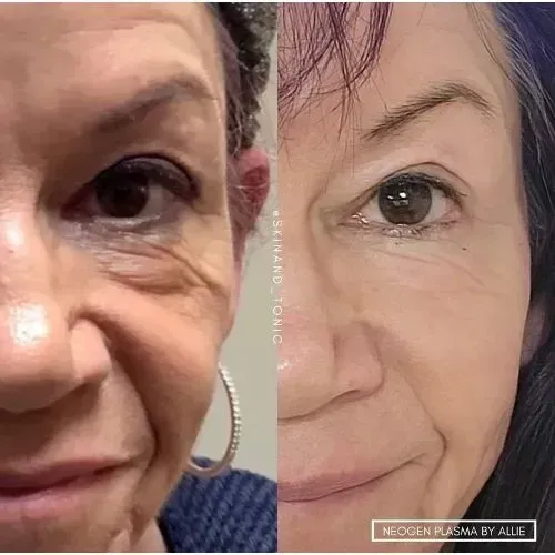 Before and after facial rejuvenation for smoother under-eye lines, Skin & Tonic Pace FL