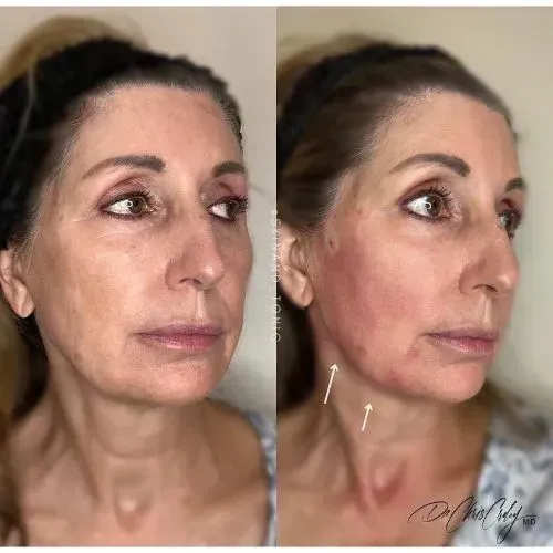 Before and after thread lift for improved jawline definition and cheek lift, Skin & Tonic Pace FL