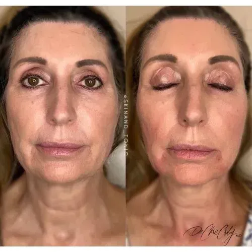 Before and after non-surgical face lift for smoother lower face contours, Skin & Tonic Pace FL