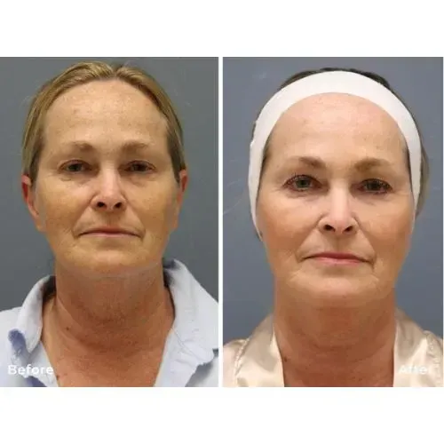 Before and after microneedling treatment for firmer skin and softer facial lines, Skin & Tonic Pace FL
