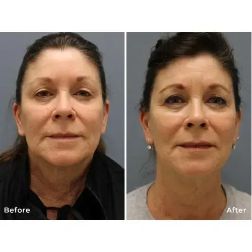 Before and after skin rejuvenation treatment for smoother facial texture, Skin & Tonic Pace FL