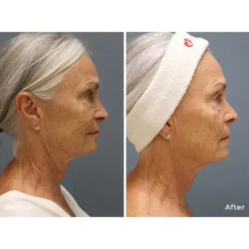 Before and after skin tightening treatment for neck and jawline firmness, Skin & Tonic Pace FL