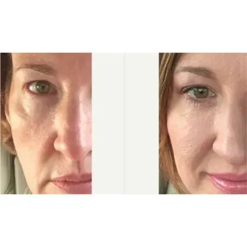 Before and after facial volume restoration for softer smile lines, Skin & Tonic Pace FL