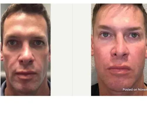 Before and after collagen-stimulating facial rejuvenation for restored volume, Skin & Tonic Pace FL