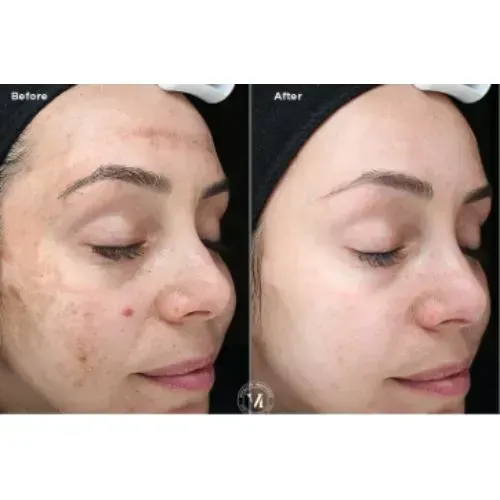 Before and after chemical peel for reduced dark spots and clearer skin, Skin & Tonic Pace FL