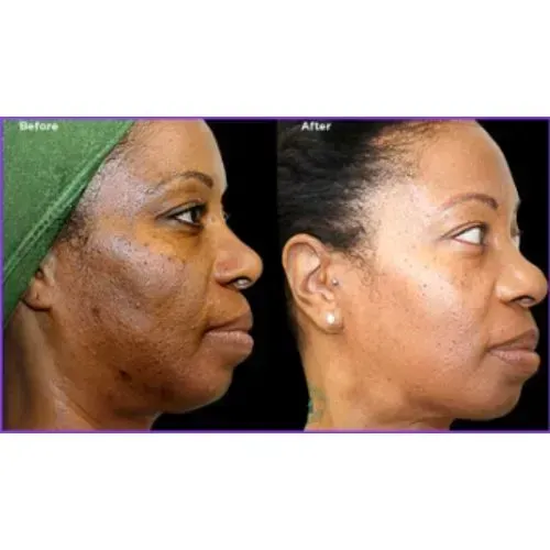 Before and after chemical peel for brighter skin tone and smoother texture, Skin & Tonic Pace FL