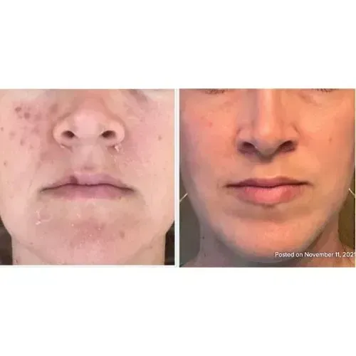 Before and after chemical peel for acne marks and more even skin tone, Skin & Tonic Pace FL