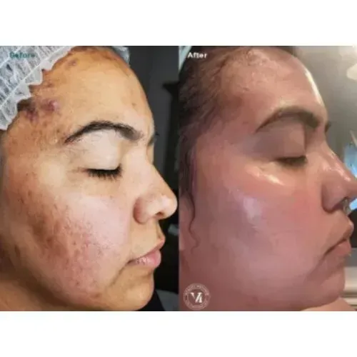 Before and after chemical peel for pigmentation and skin brightening, Skin & Tonic Pace FL