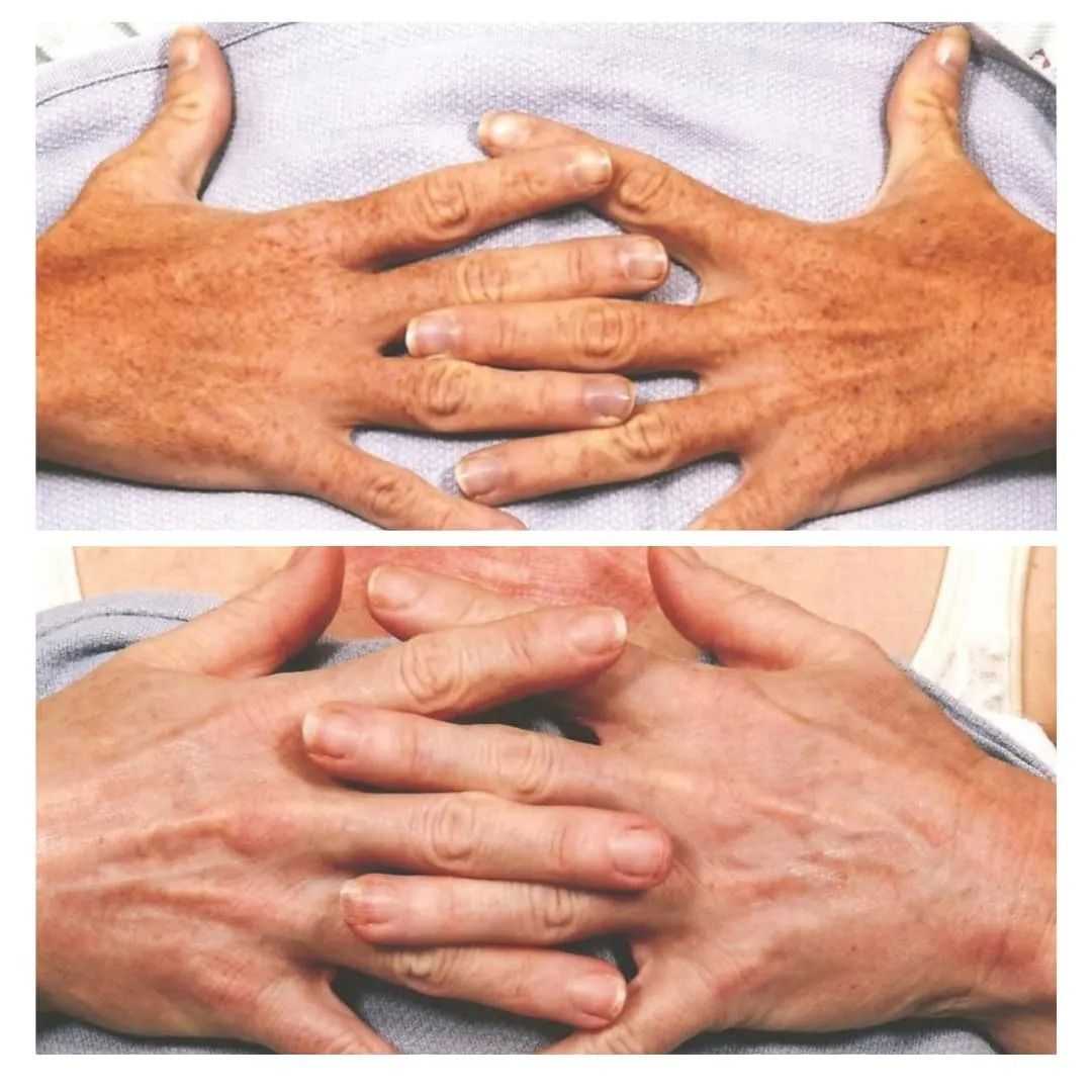 Before and after hand rejuvenation for sun damage and smoother skin, Skin & Tonic Pace FL