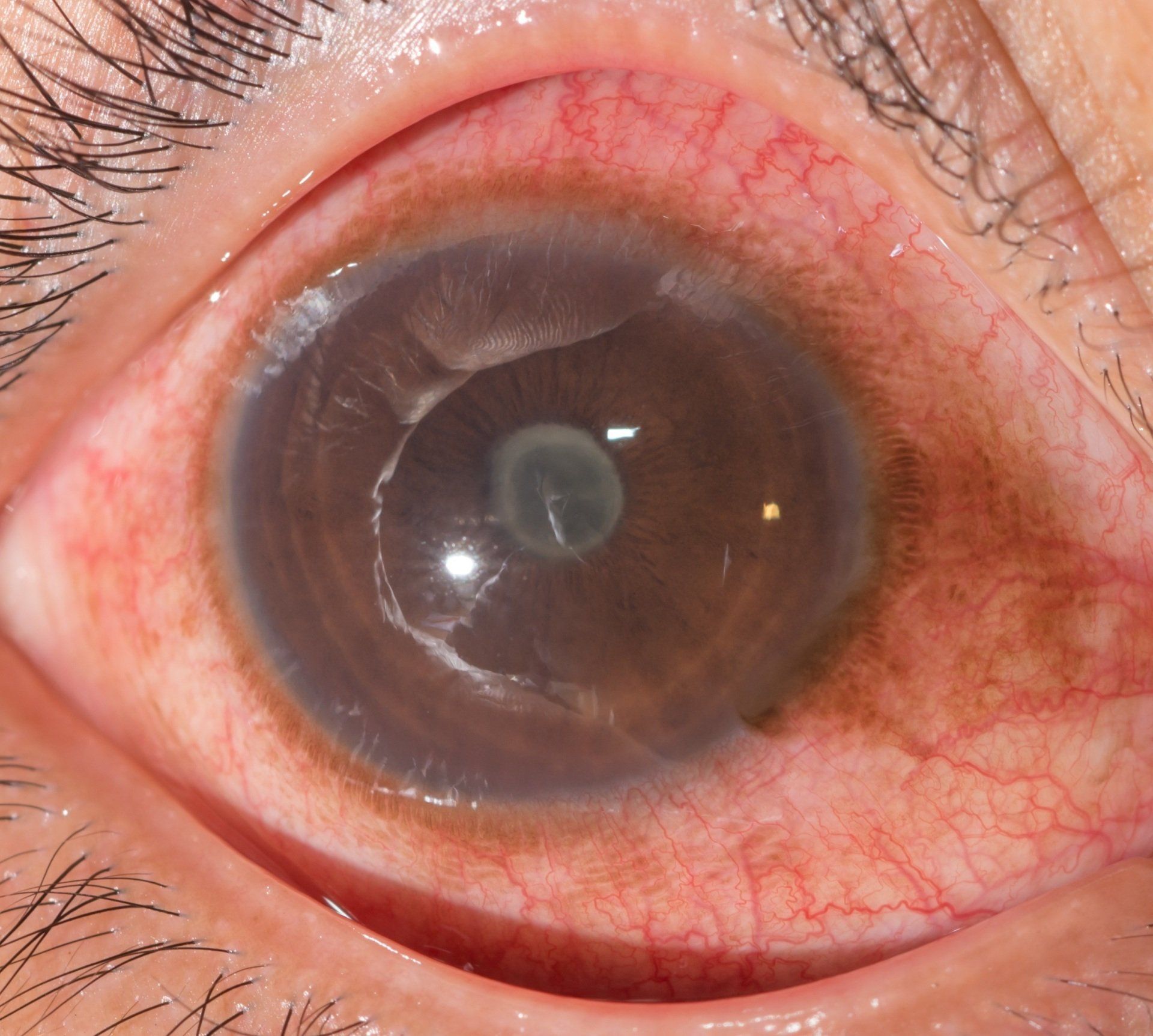 Anterior Uveitis