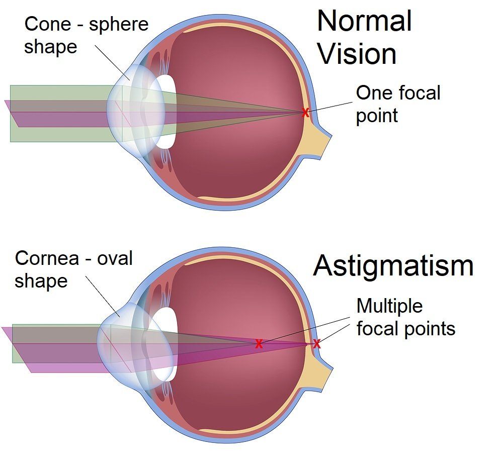 Astigmatism Astigmatism