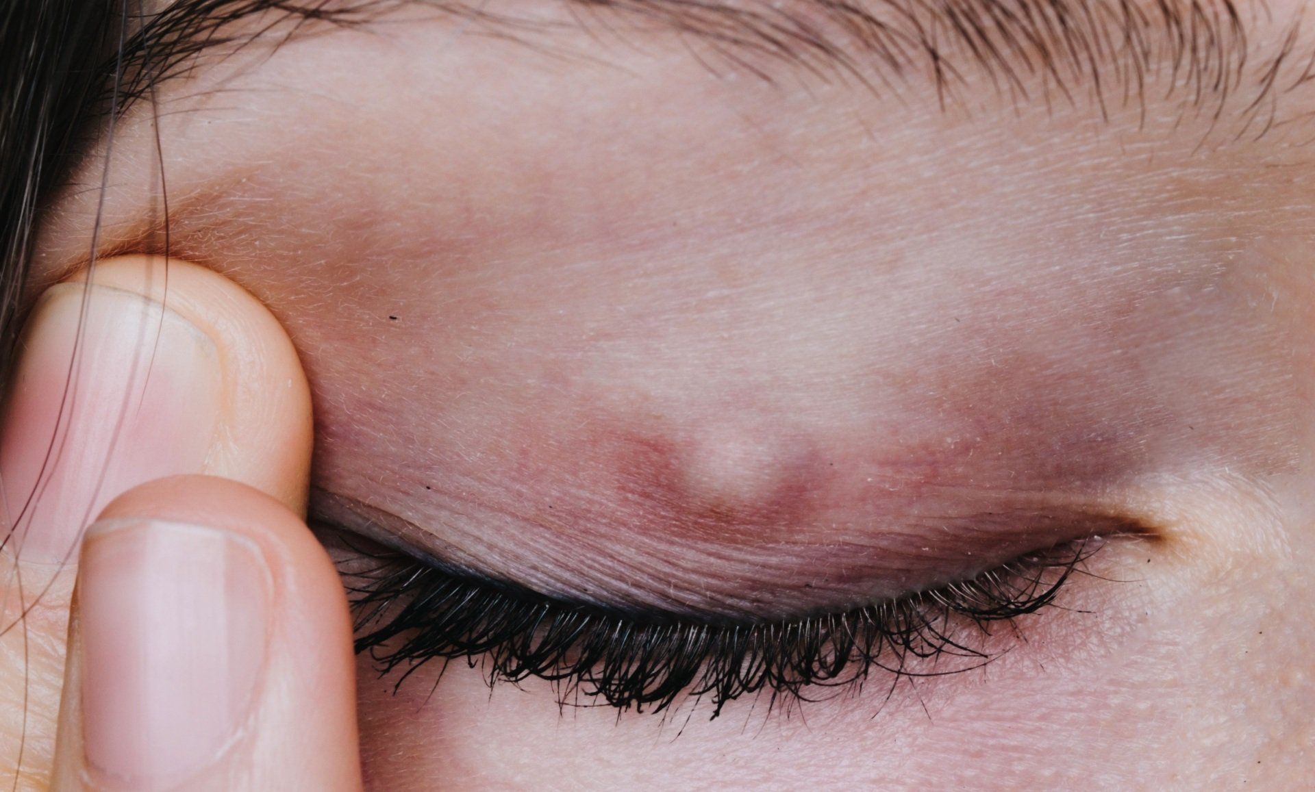 Chalazion