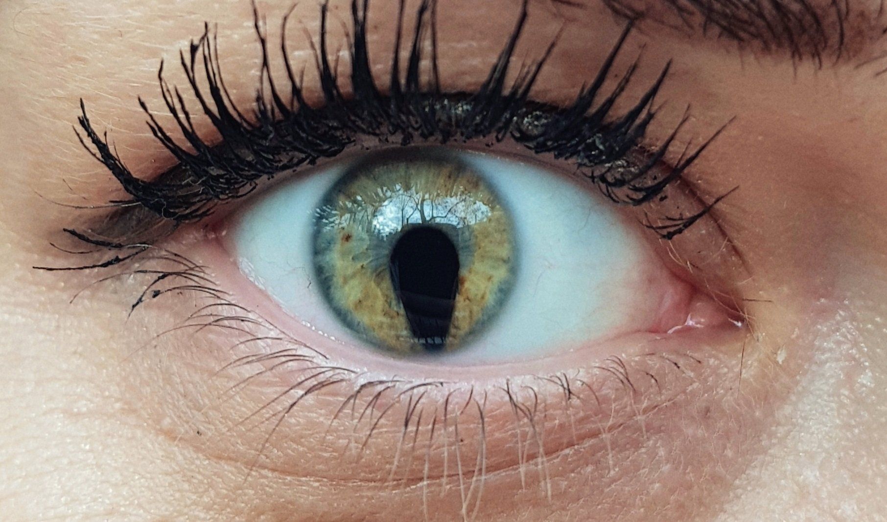 Coloboma