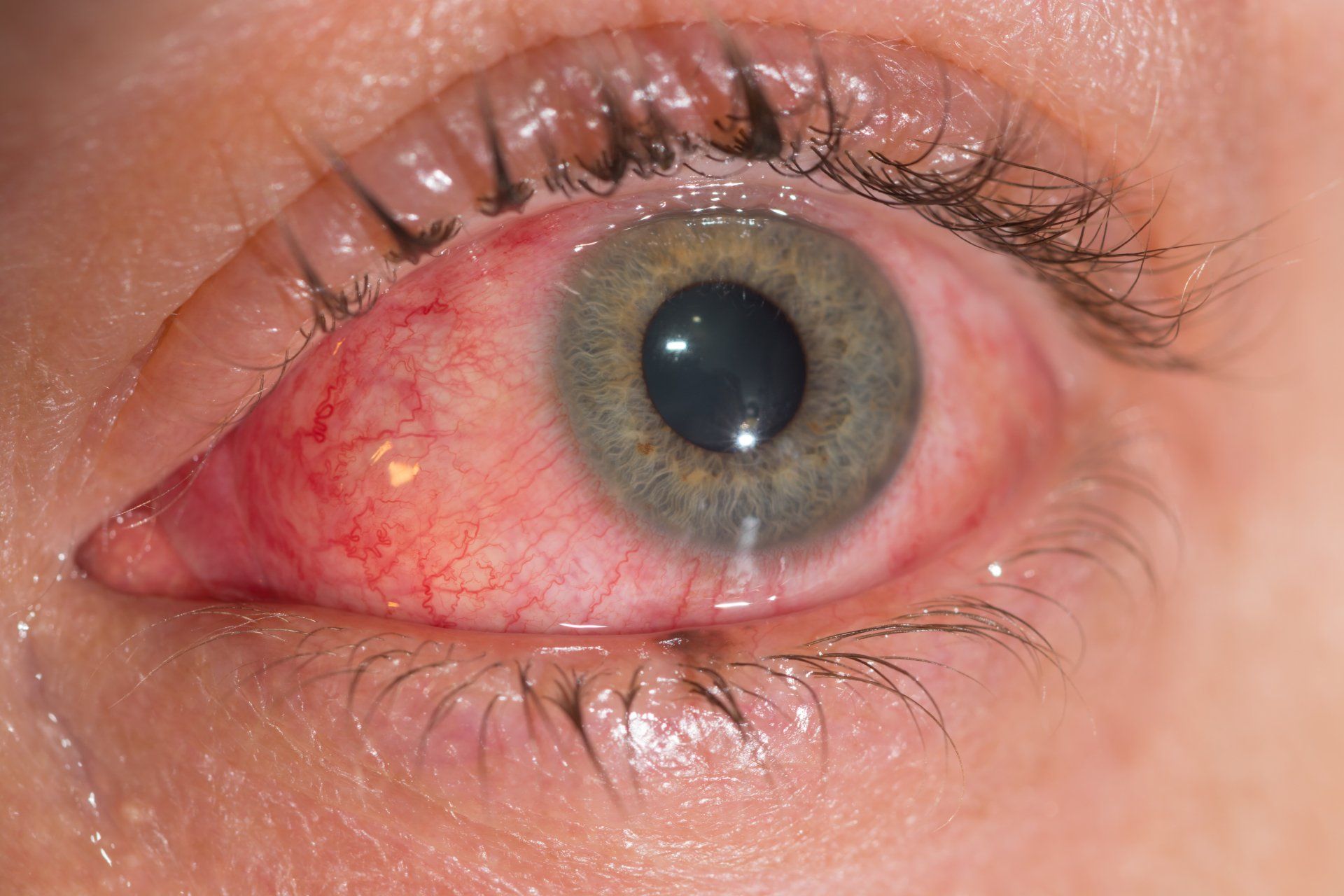 Conjunctivitis or 