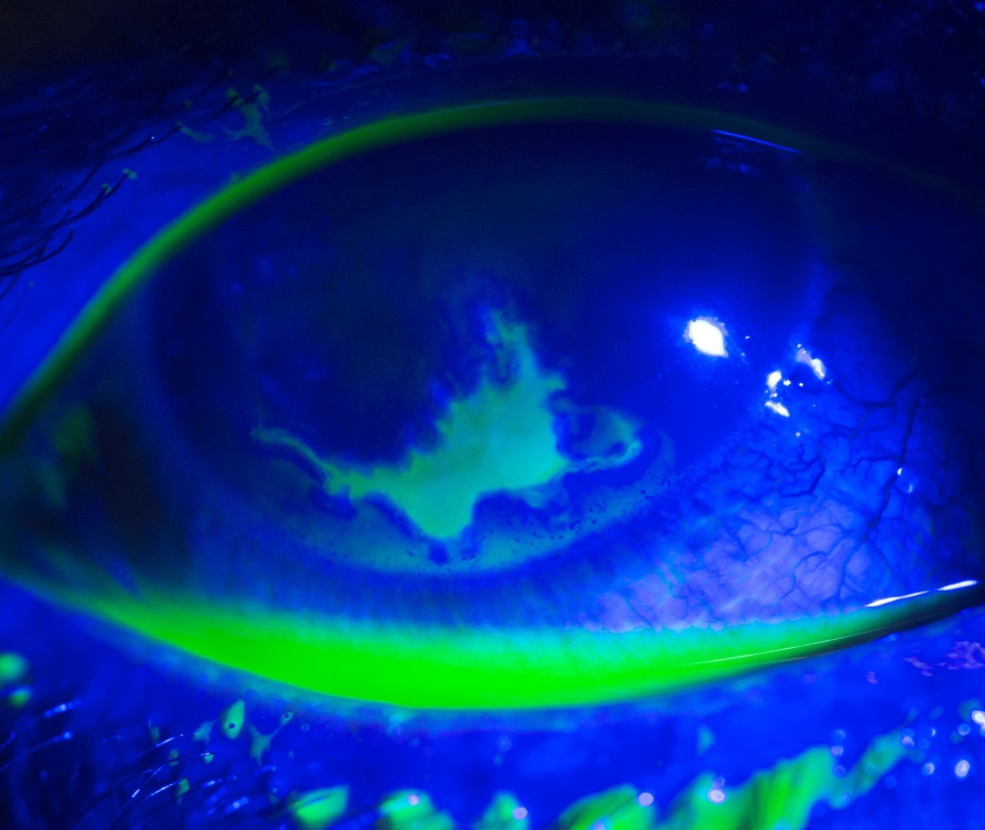 Corneal Abrasion