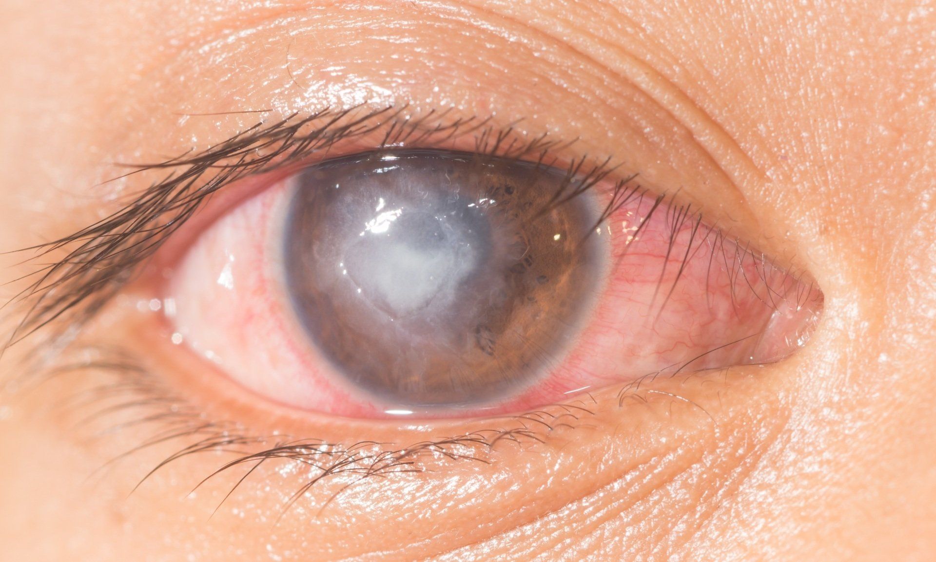 Central Corneal Ulcer