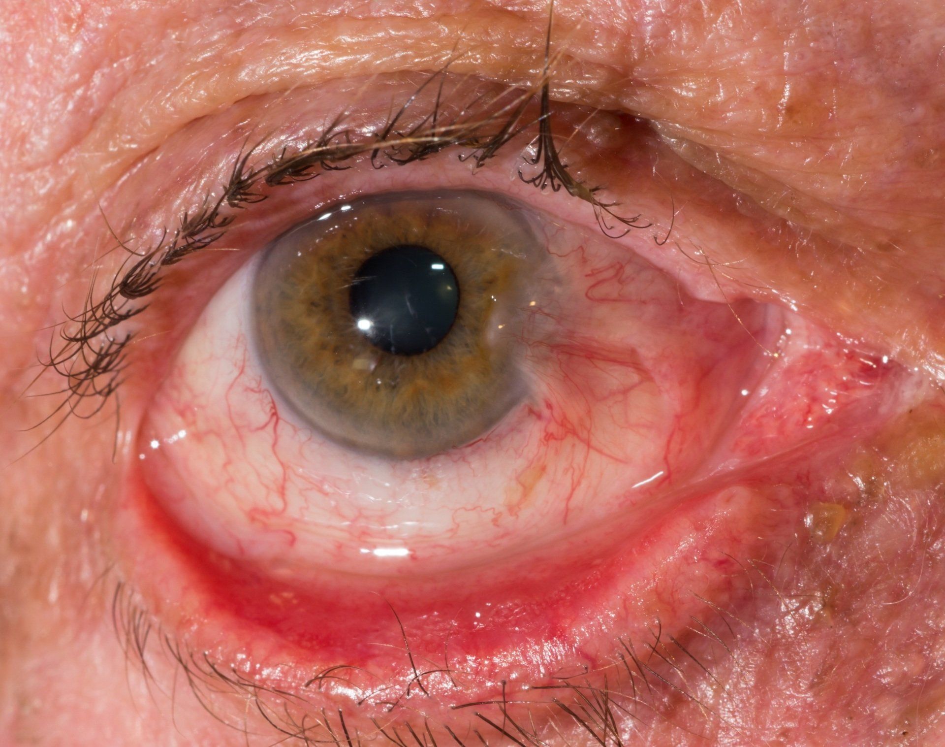 Ectropion