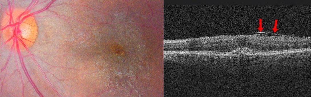 Epiretinal Membrane