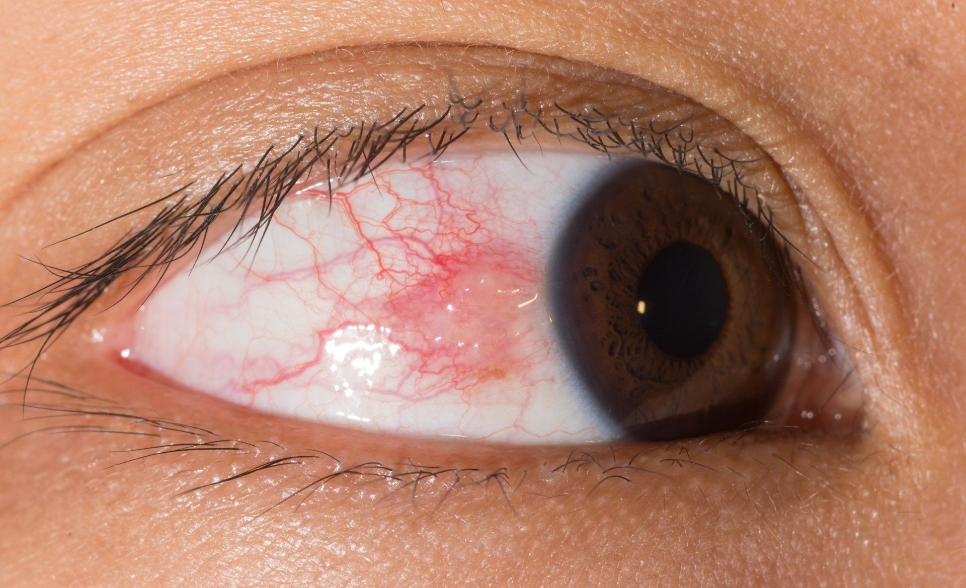 Episcleritis