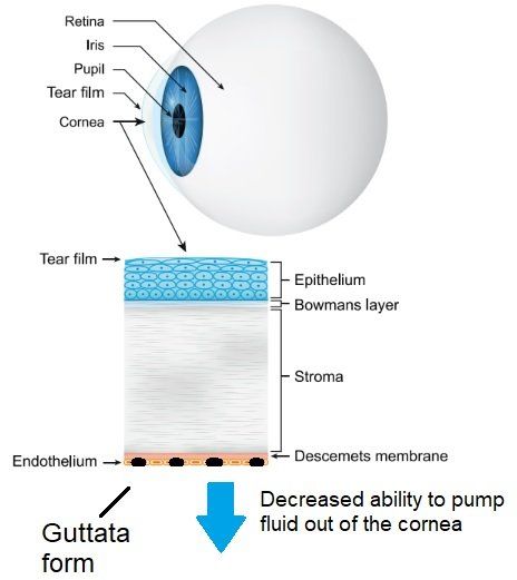 Cause of Fuch's Dystrophy Fuch's Dystrophy