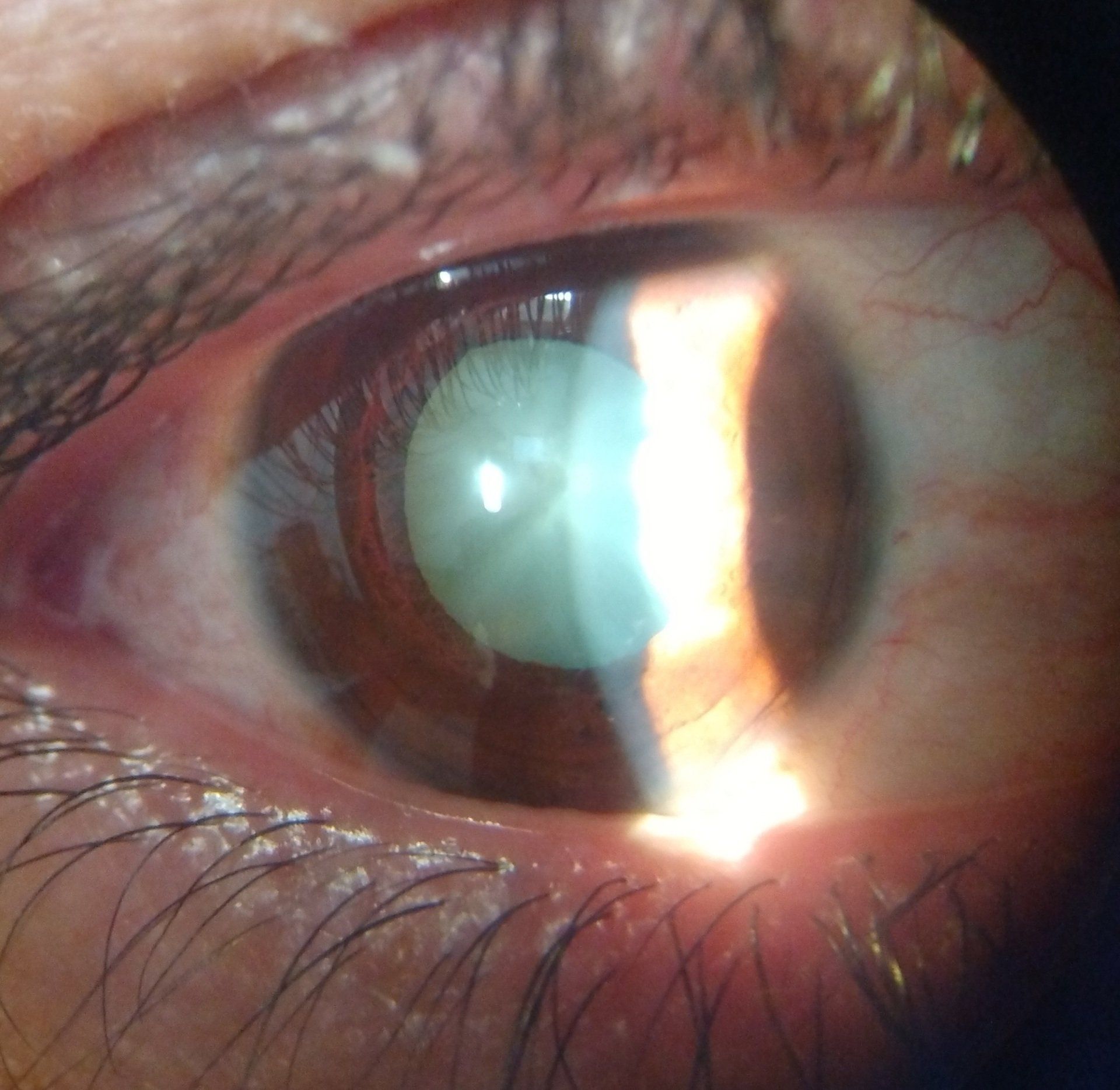 Hypermature nuclear cataract