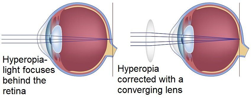 Hyperopia Diagram Hyperopia Diagram