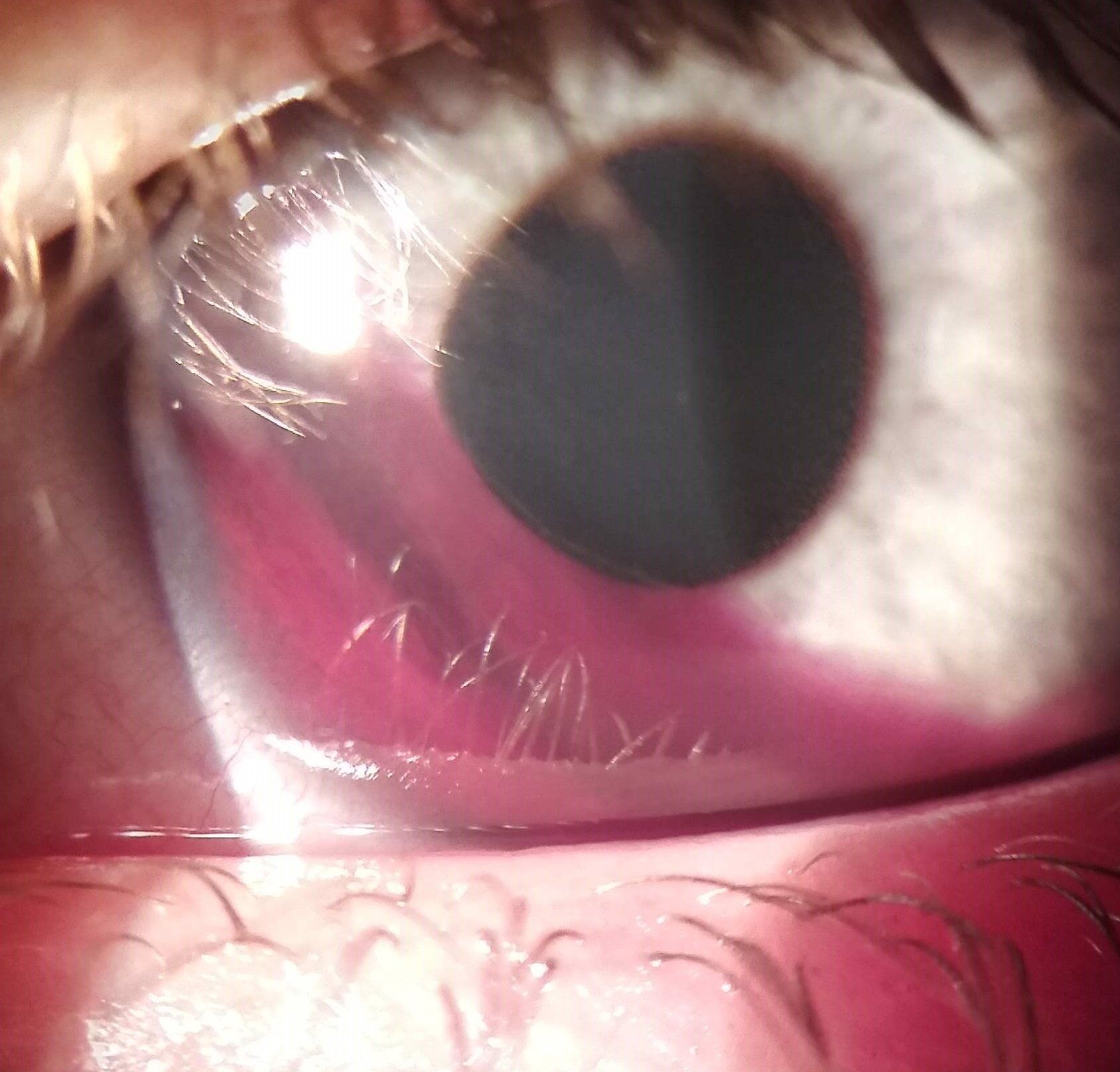 Hyphema