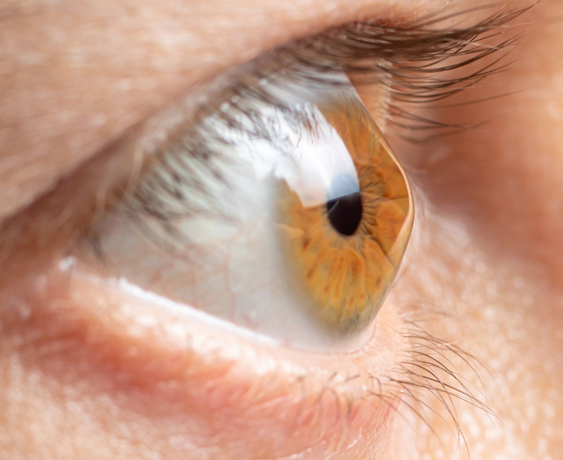 Keratoconus