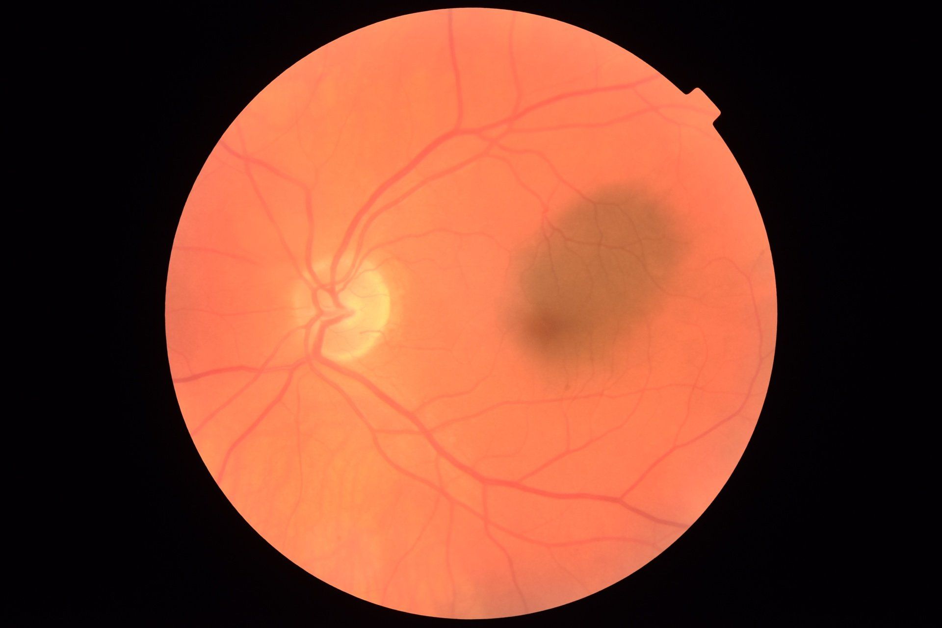 Large choriodal nevus