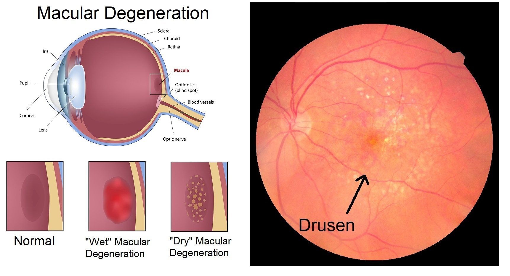 Macular Degeneration Macular Degeneration