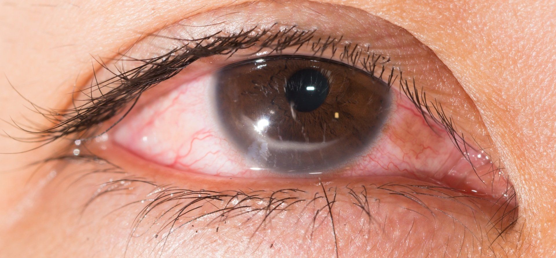 Marginal Keratitis