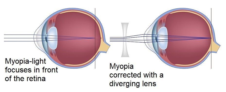 Myopia Diagram Myopia Diagram