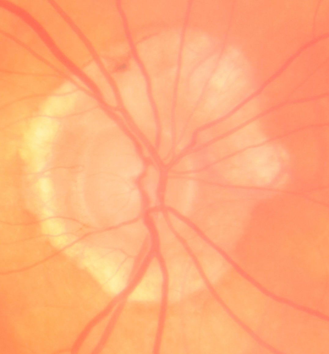 Myopic ring seen in pathologic myopia
