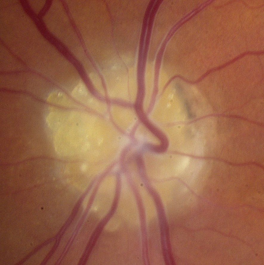 Optic Nerve Head Drusen