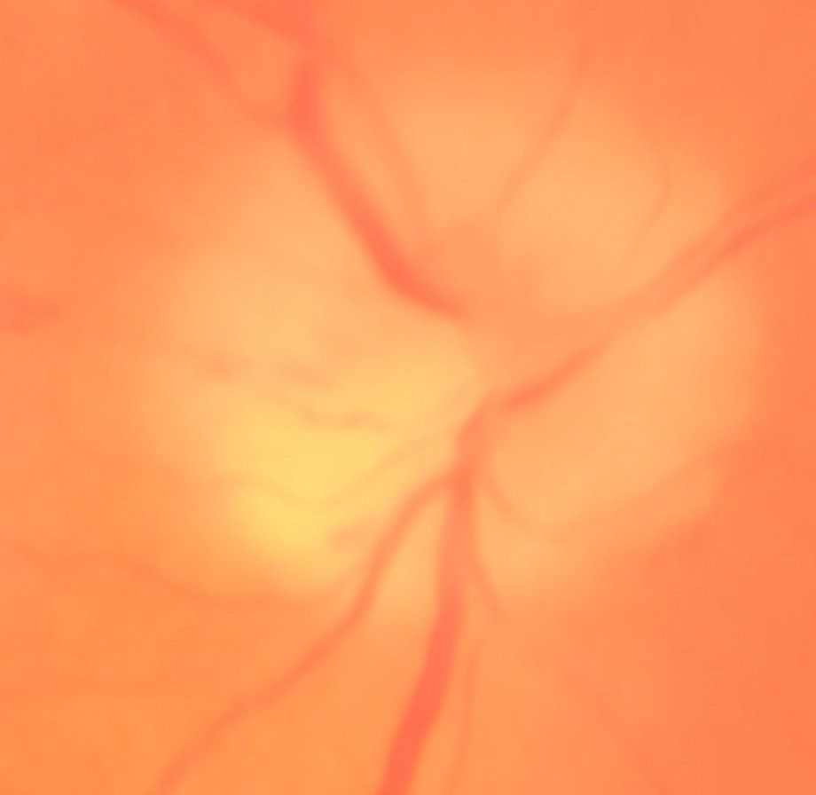 Optic Neuritis