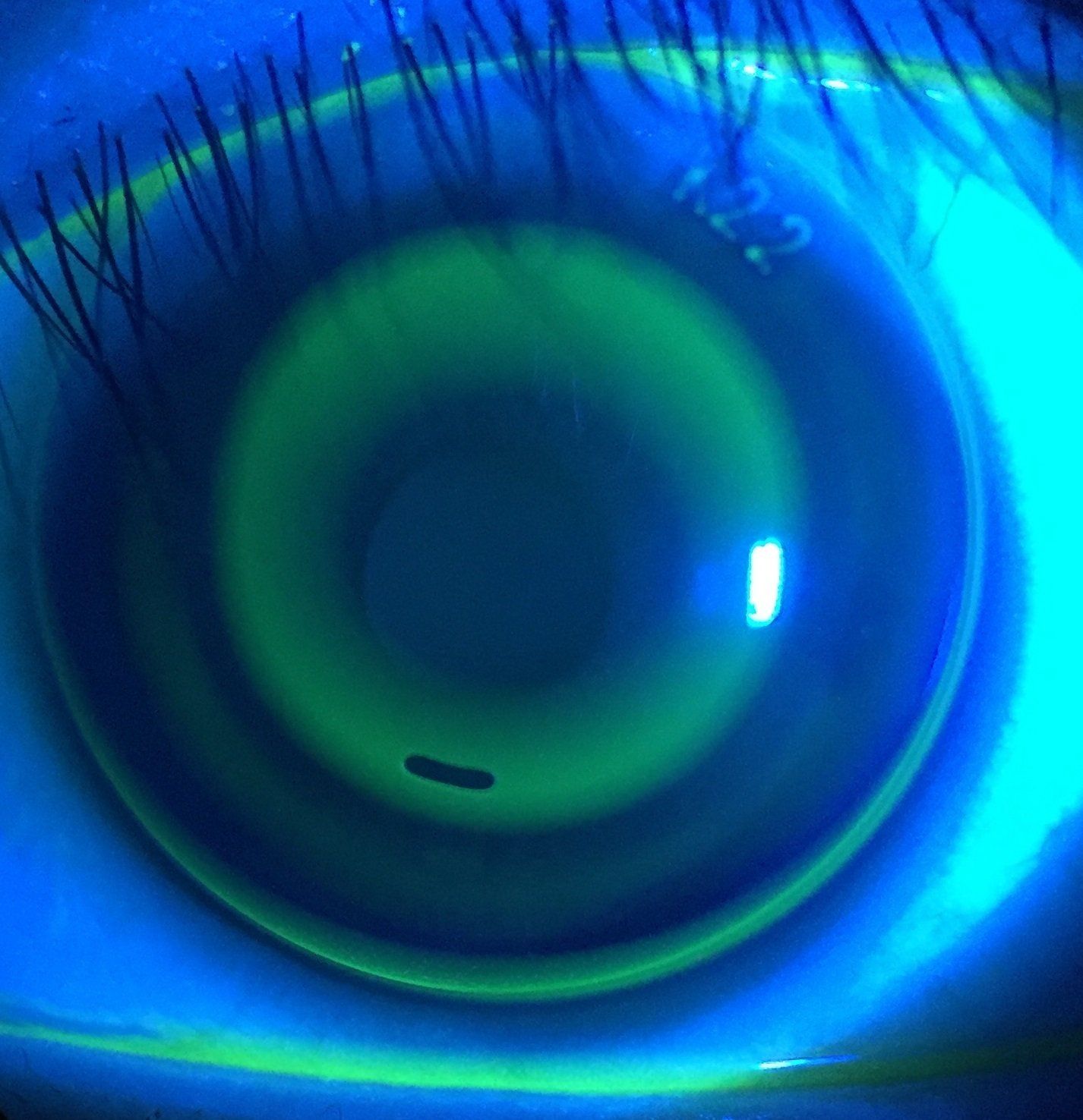 Orthokeratology