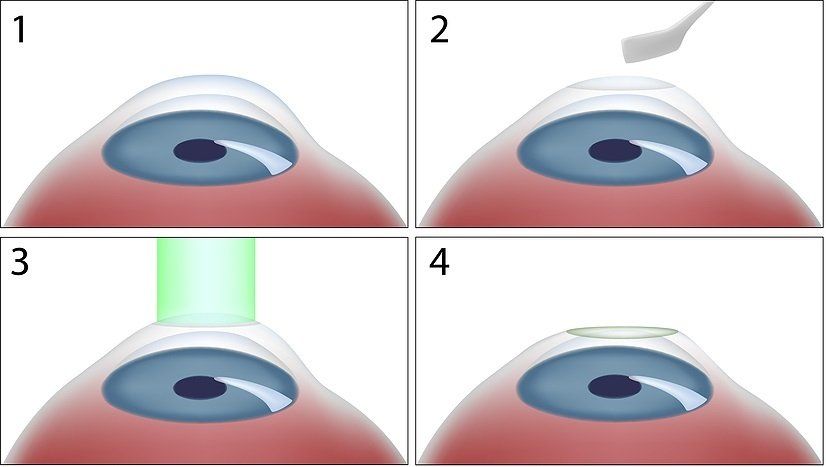 Photorefractive Keratectomy (PRK)