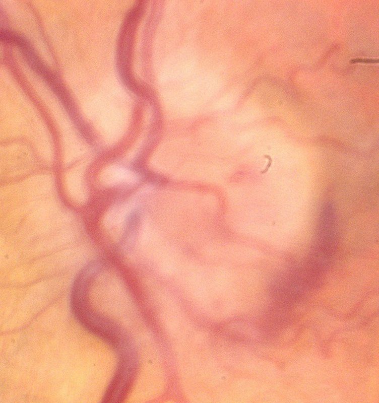 Swollen nerve head as seen in papilledema