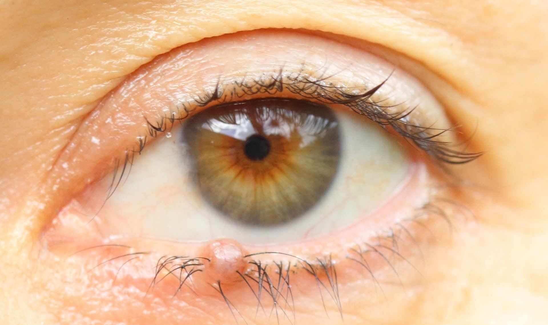 Papilloma on lower lid