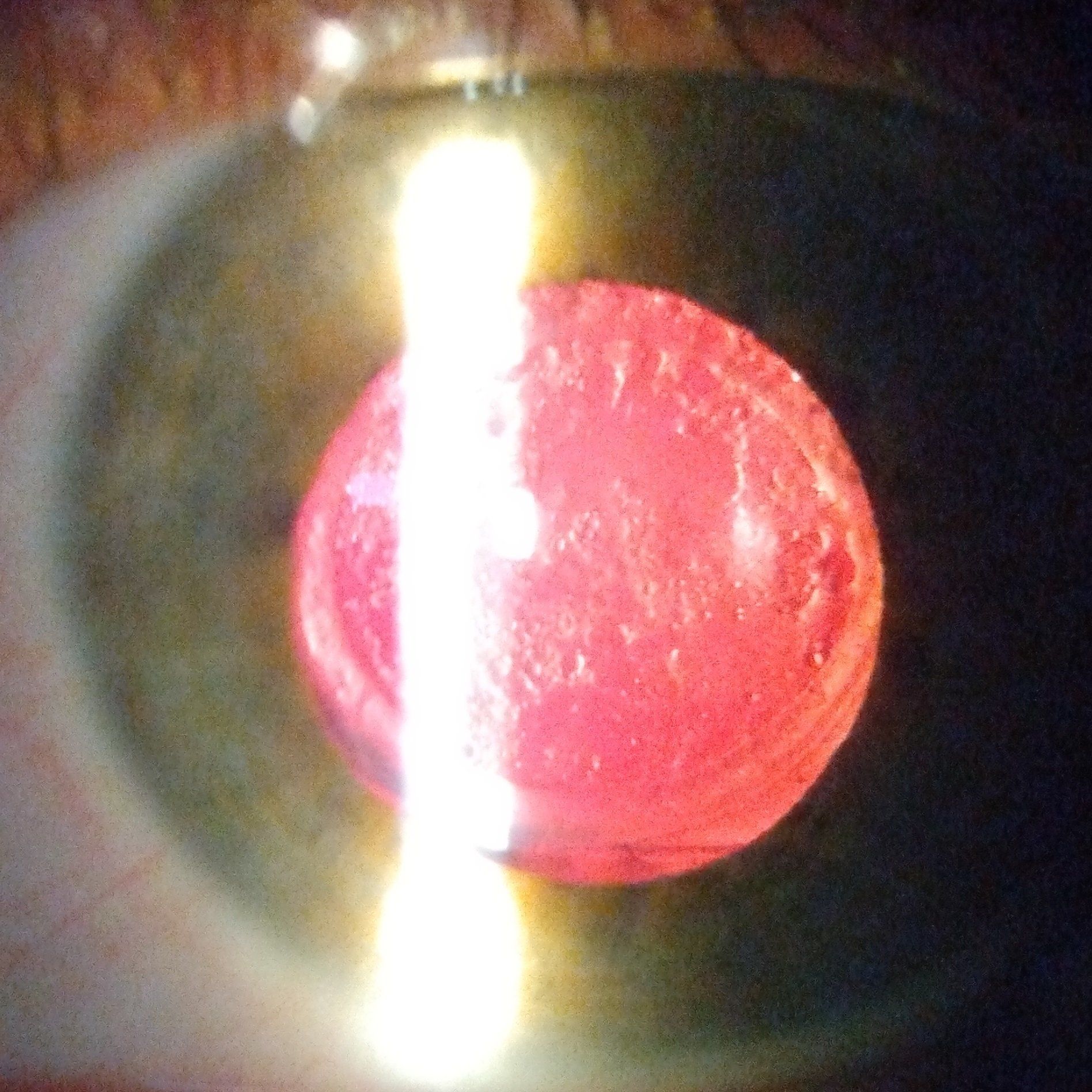 Posterior Capsular Opacification